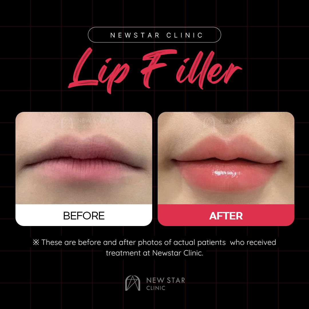 뉴스타 피부과 입술 필러 시술 전후