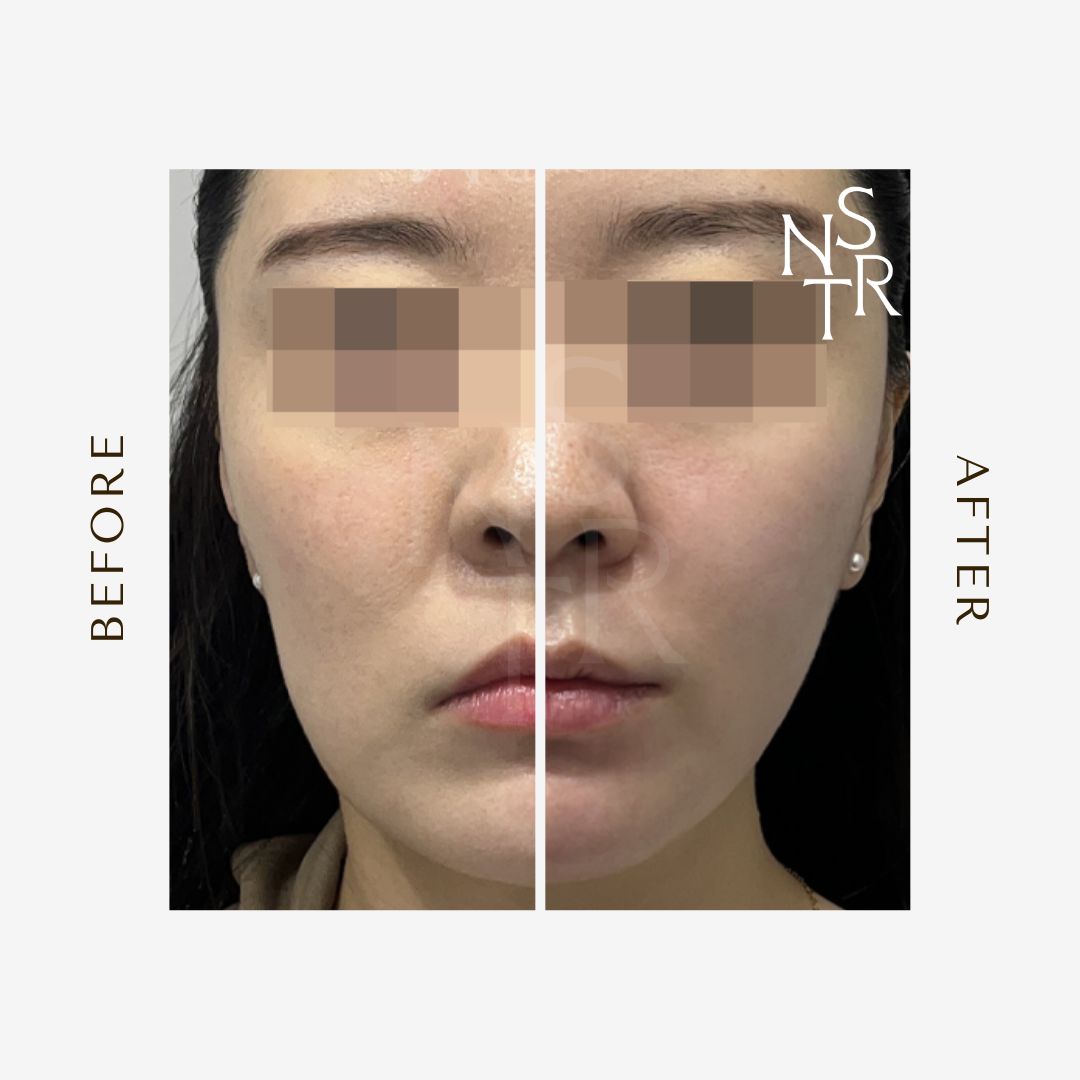 뉴스타피부과 온다 리프팅 및 티타늄 리프팅 시술