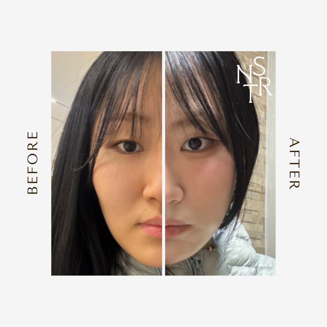 뉴스타 피부과 관자놀이 필러 시술